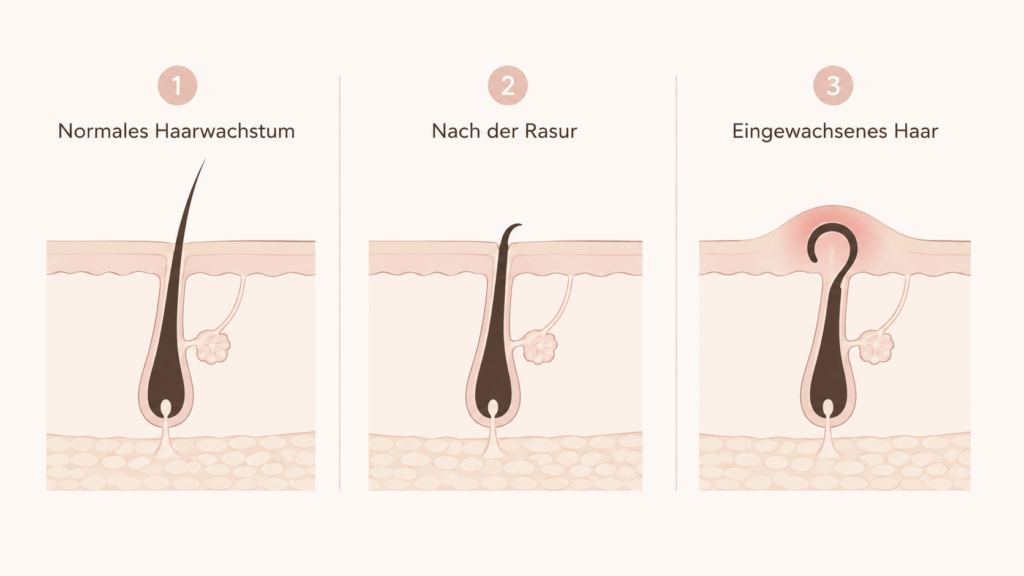 Illustration zur Entstehung eingewachsener Haare im Intimbereich. Mit KI generiert.